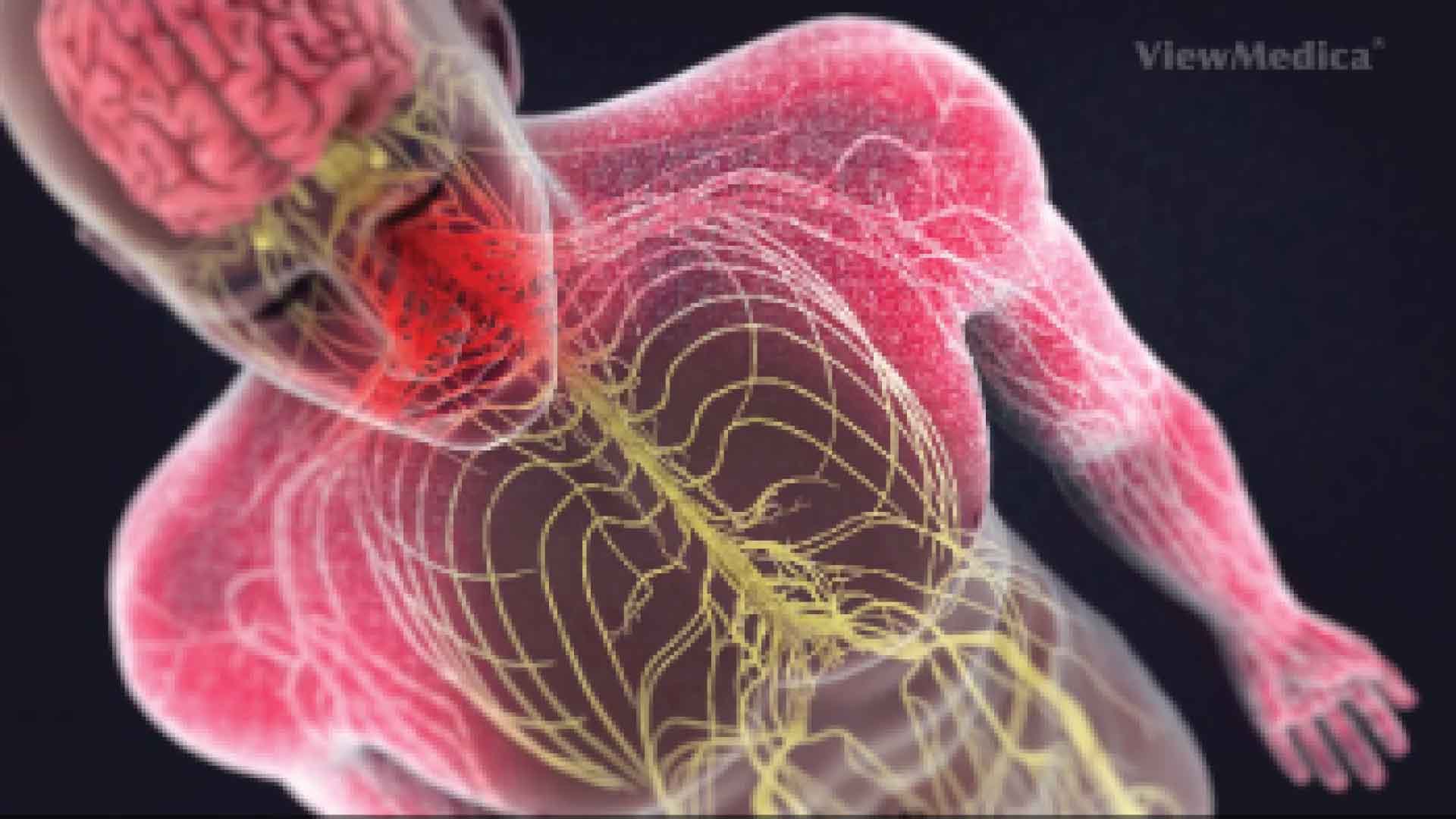 Cervical radiculopathy