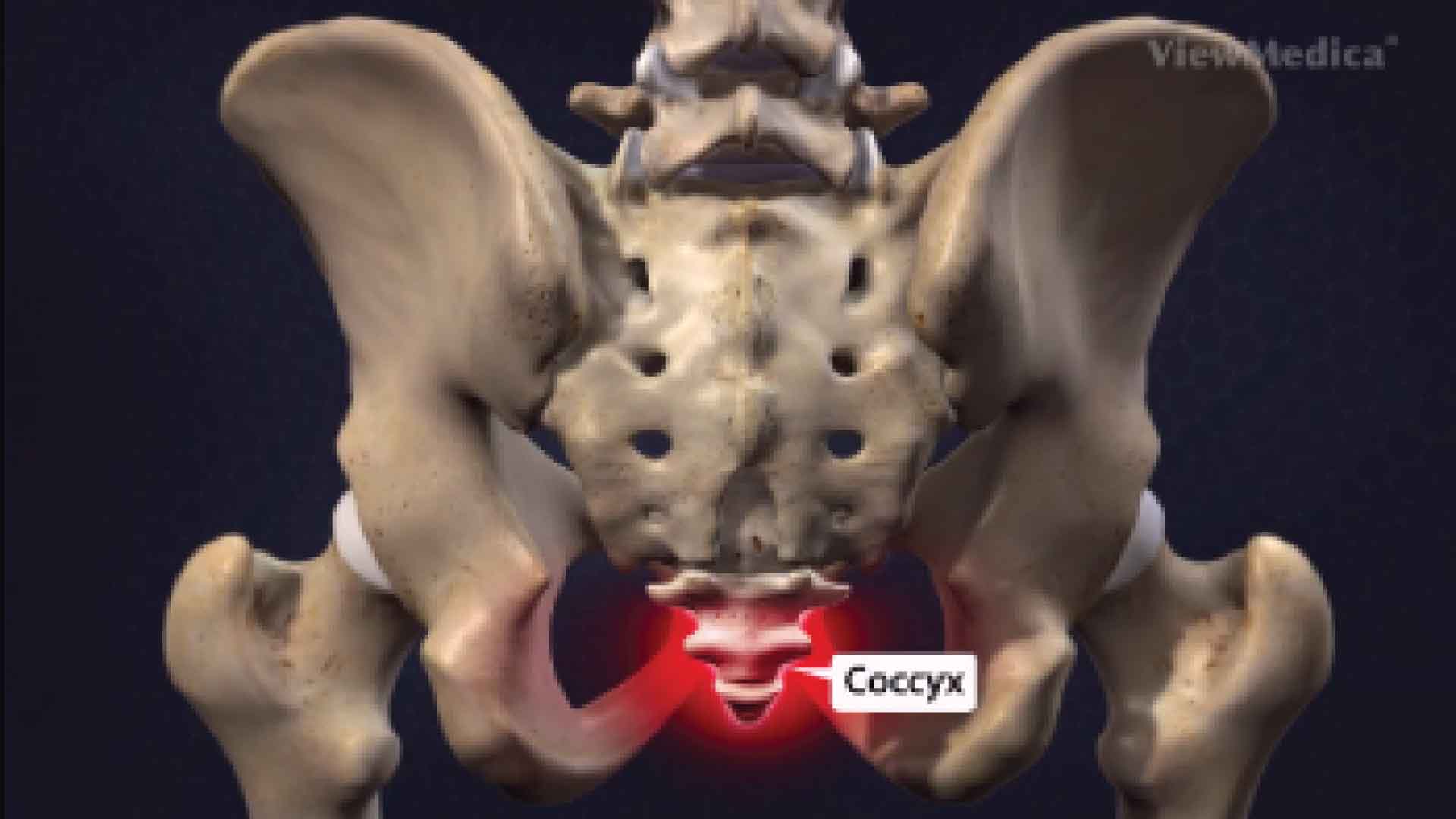 Coccydynia