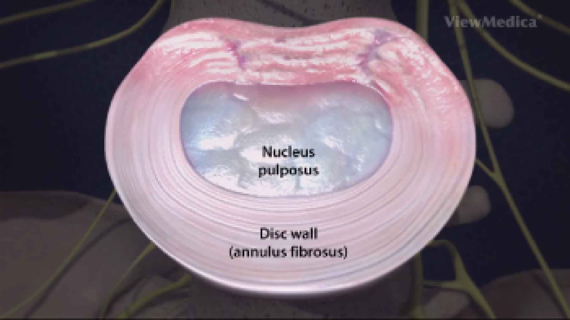 Degenerative disc disease