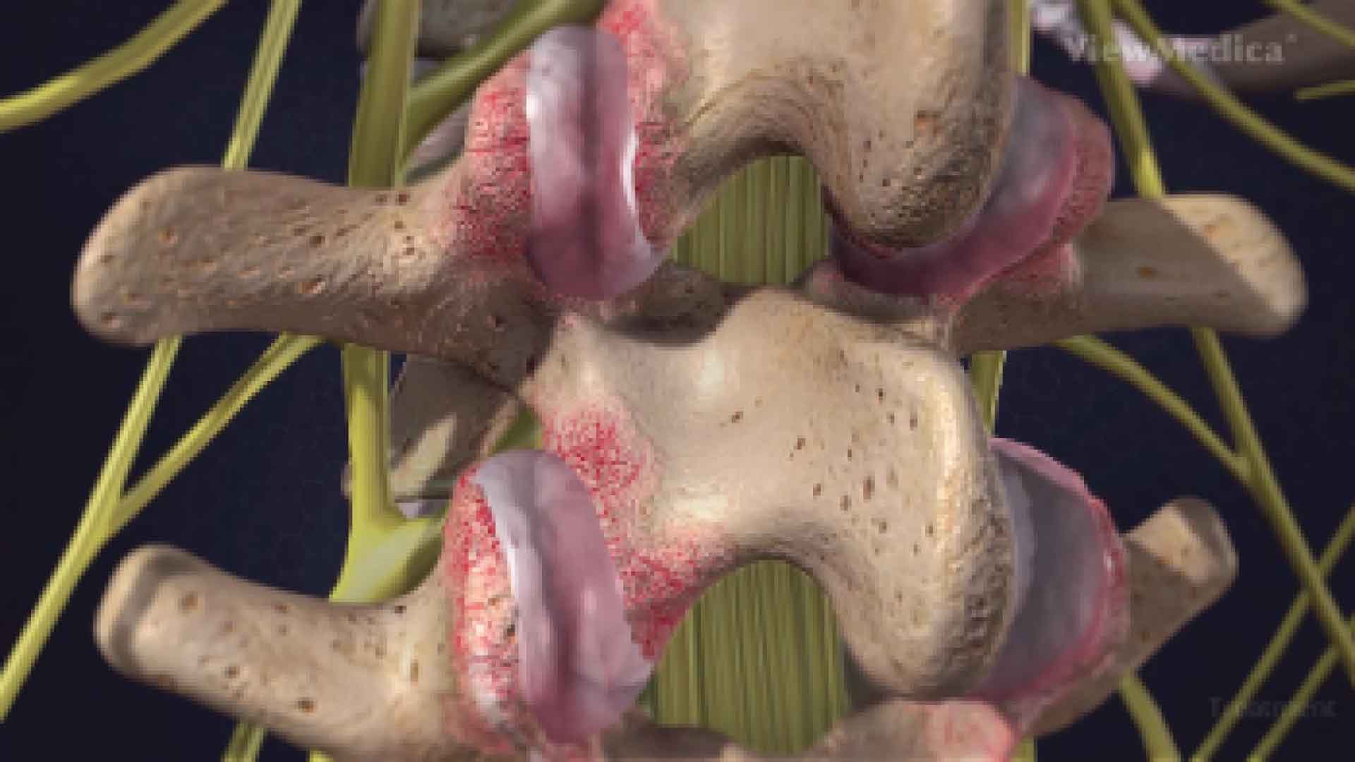 Facet joint syndrome