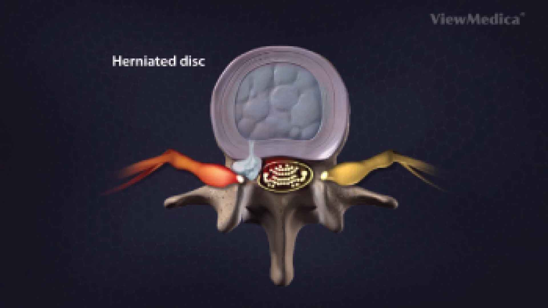 Herniated disc