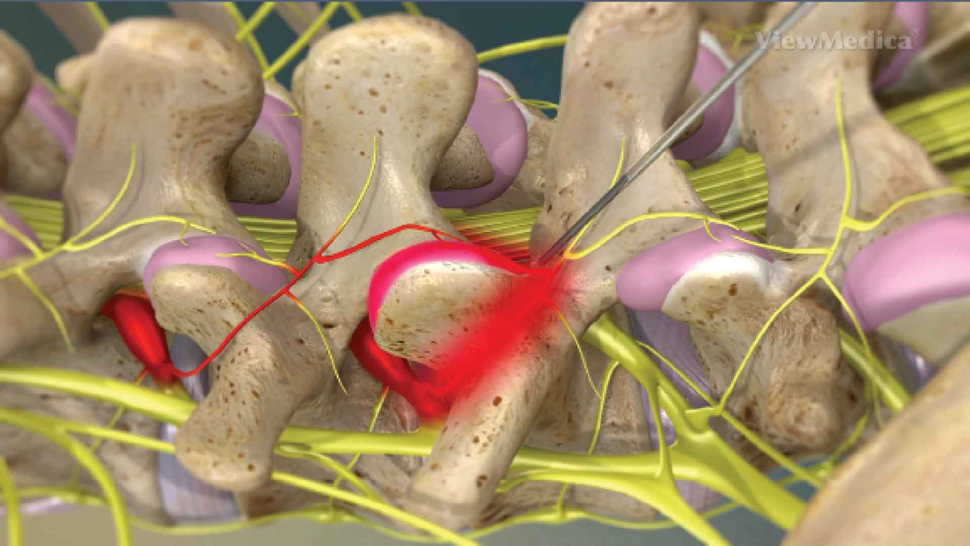 Facet joint radiofrequency