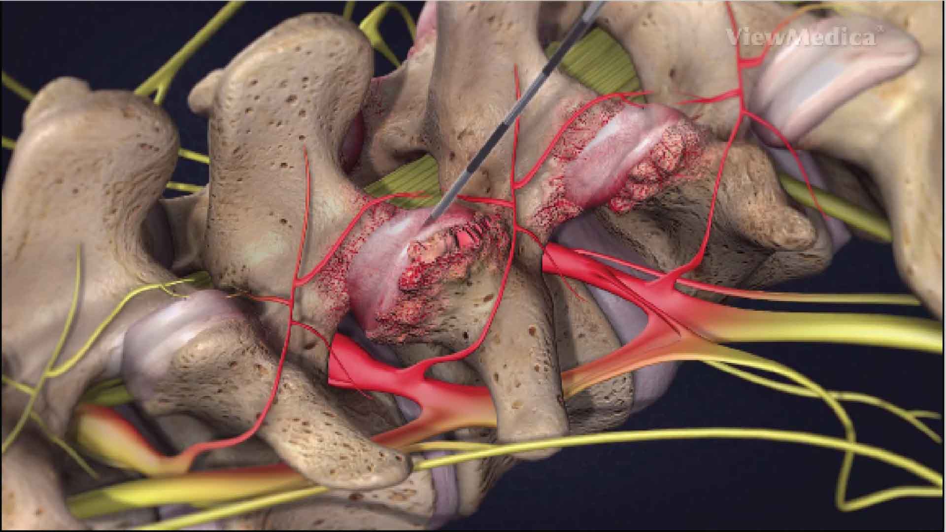 Facet joint injection