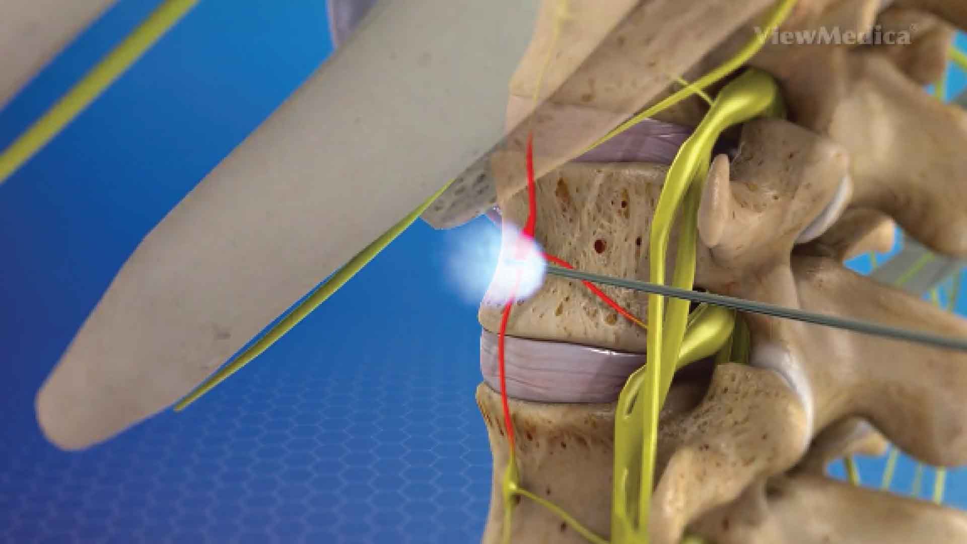 Sympathetic nerve treatment